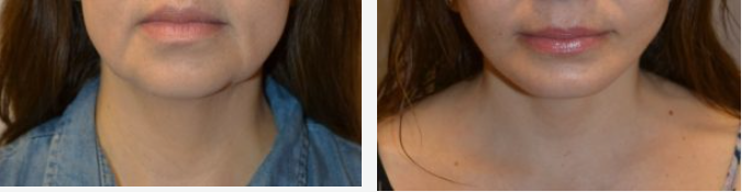 Before and after photos of a person's lower face and neck, showing a change in the skin.