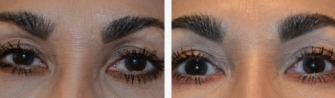 Two close-up photos of a person's eyes and eyebrows, possibly before and after a procedure.