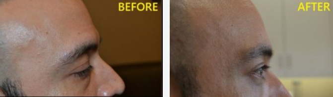 A side-by-side comparison shows a man's forehead and eye 