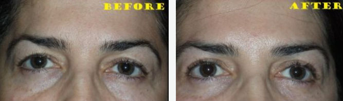 Comparison of a person's eyes before and after a cosmetic procedure. The 
