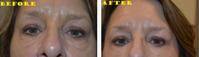 Before and after comparison of eyes, showing reduction in wrinkles.