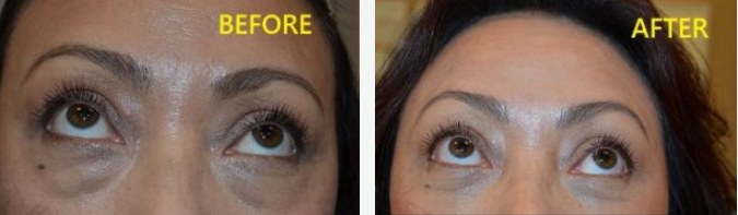 Comparison of eyes before and after a treatment, showing a reduction in under-eye darkness and puffiness.