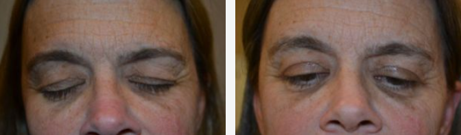 Close-up of a person's eyes, one closed and one partially open, showing potential asymmetry.