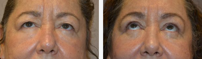 Before and after images of a person's eyes, showing a possible cosmetic procedure.