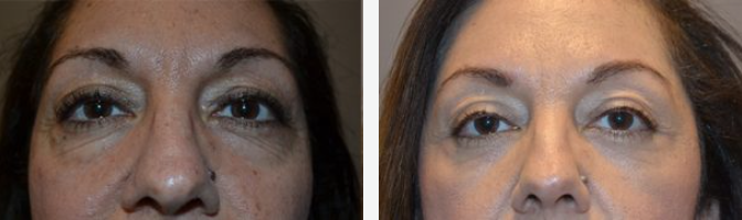 Before and after close-up of a person's eyes, showing reduction in wrinkles and puffiness after treatment.