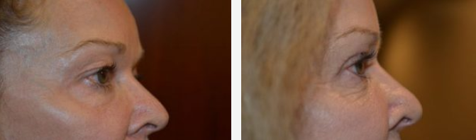 Two side-by-side portraits of a woman's profile, one before, one after rhinoplasty.