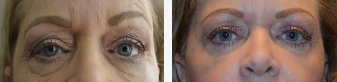 Side-by-side comparison of a person's eyes before and after a treatment. Eyes are blue and wear eye makeup.