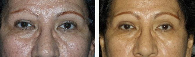 Two side-by-side images of a person's eyes, showing a before-and-after effect of a cosmetic procedure.