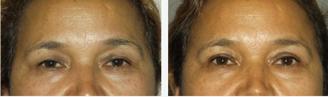 Two close-up photos of eyes. The one on the right shows a slightly bronzed complexion.