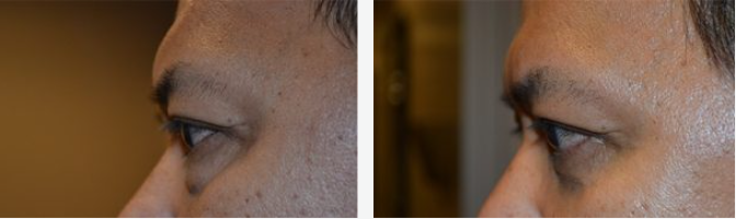 Two side-profile views of a person's eye, eyebrow, and nose. Skin tone is light.