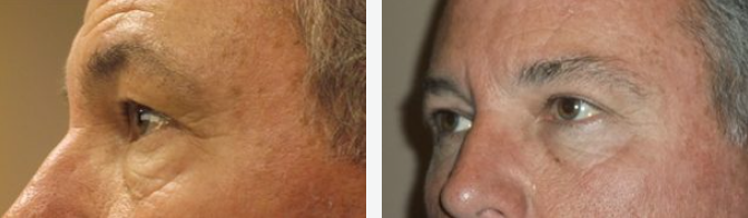 Two close-up photos of a man's eyes, showing a possible before and after comparison of a cosmetic procedure.