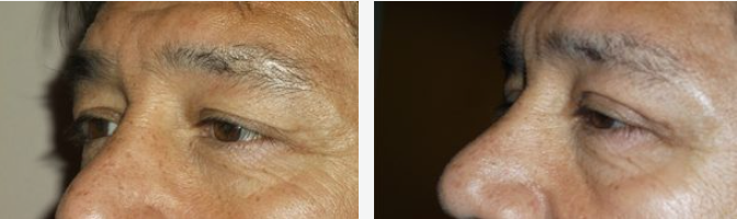 Two side-by-side images of a person's eyes and nose, likely before and after a cosmetic procedure.