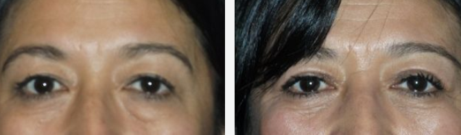 Two close-up photos of a person's eyes, before and after a treatment, showing fewer wrinkles.