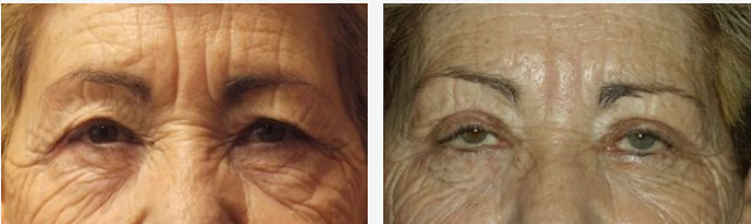 Before and after comparison of an individual's eyes, showing wrinkle reduction.