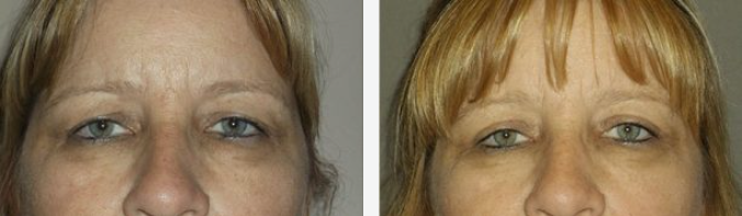 Before and after photos of a person's eyes, showing a reduction in wrinkles and a slightly lifted brow after treatment.