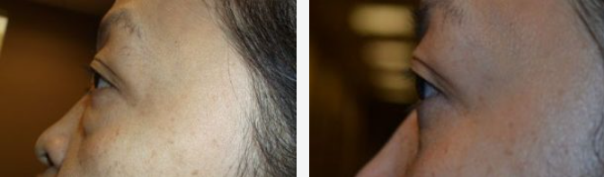 Profile view of a person's face, comparing before and after the treatment.