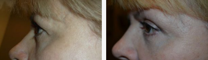 Two side-by-side profile photos of a person's face; possibly showing a before-and-after nose procedure.