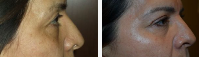 Two side-profile views of a person's nose and face: before and after a procedure.