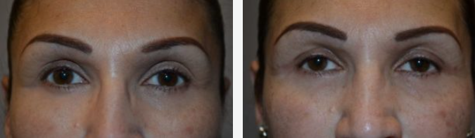 Before and after photos showing a person's eyes, appearing less puffy after treatment.