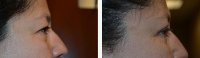 Profile view of a person's face before and after a cosmetic procedure, focusing on the nose and brow.