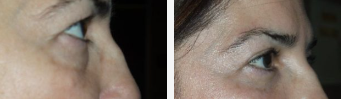 Two close-up side views of eyes. The left eye is partially closed, the right one open. Skin wrinkles are visible.