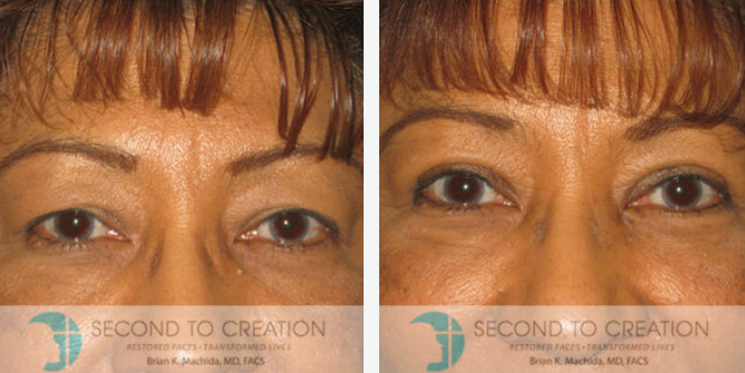 Comparison of a person's eyes before and after an eyelid lift surgery.