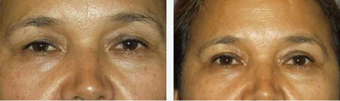 Two close-up photos of a person's eyes, before and after treatment, showing reduction in dark circles.