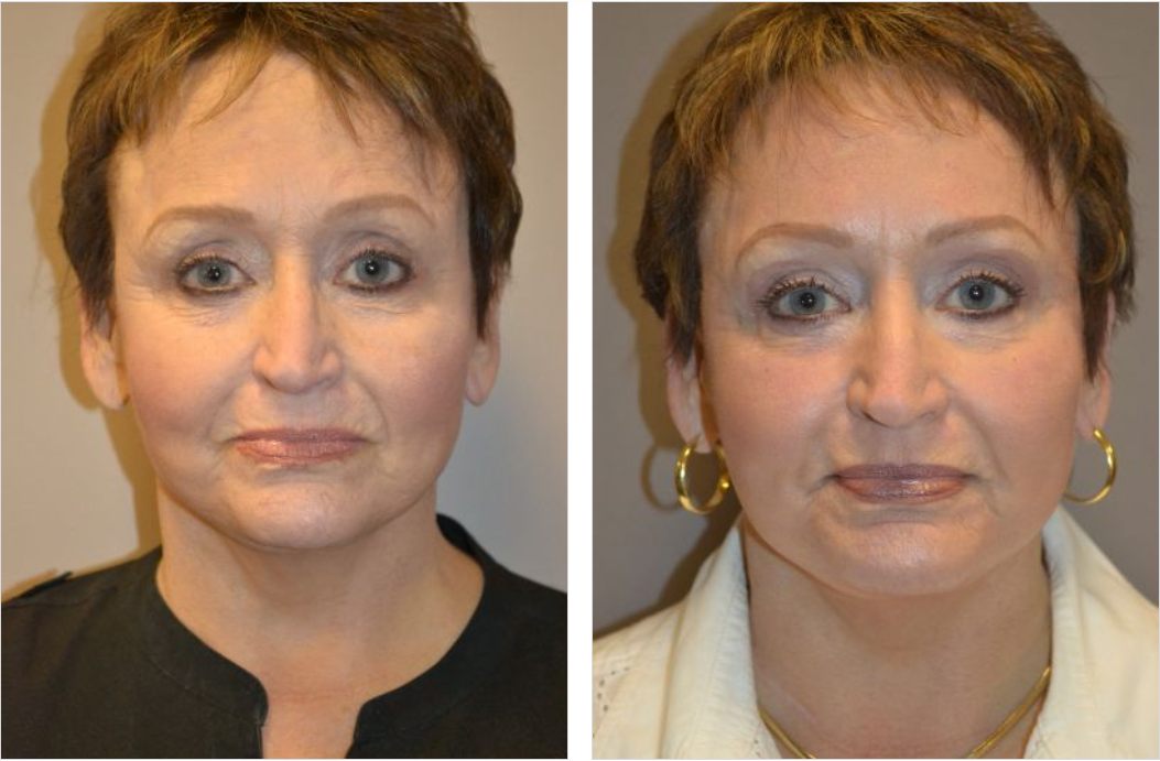 Before and after photos of a person's face; visible change in facial appearance.