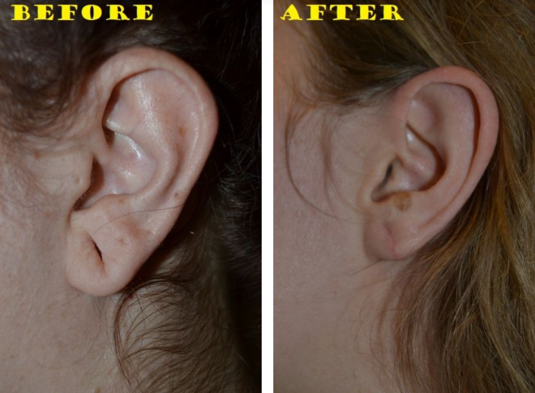 Before and after view of ear surgery; the 