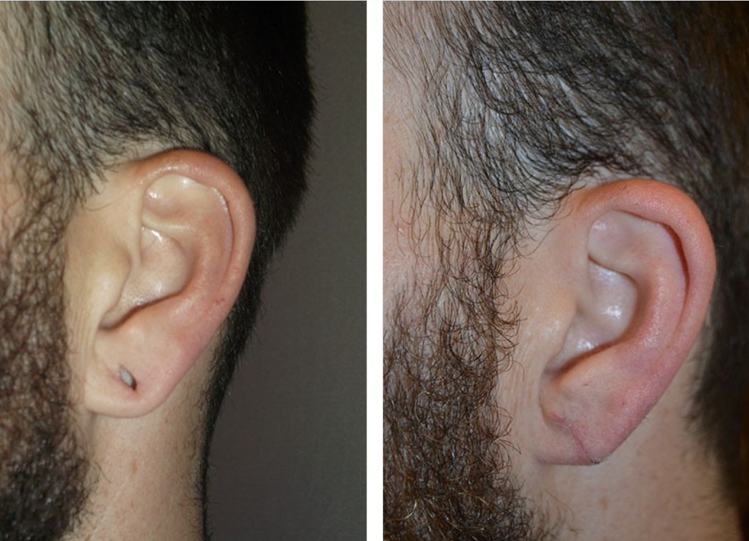 Comparison of a man's ears: left ear pierced, right ear unpierced, both against a light background.