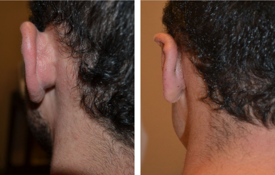 Before and after photos of a person's ear surgery. The ears appear less protruding in the after photo.