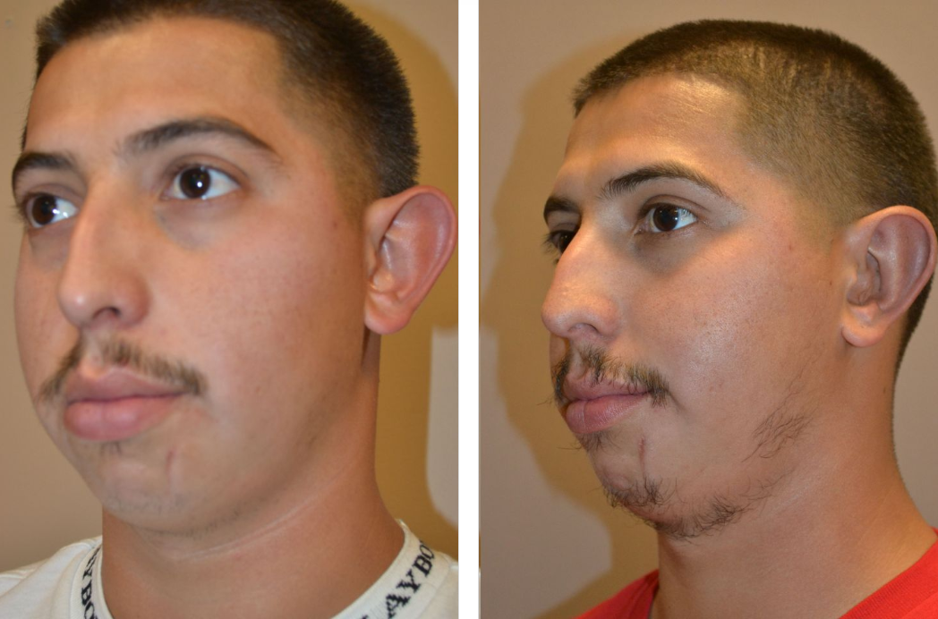 Man before and after otoplasty surgery to pin back ears.