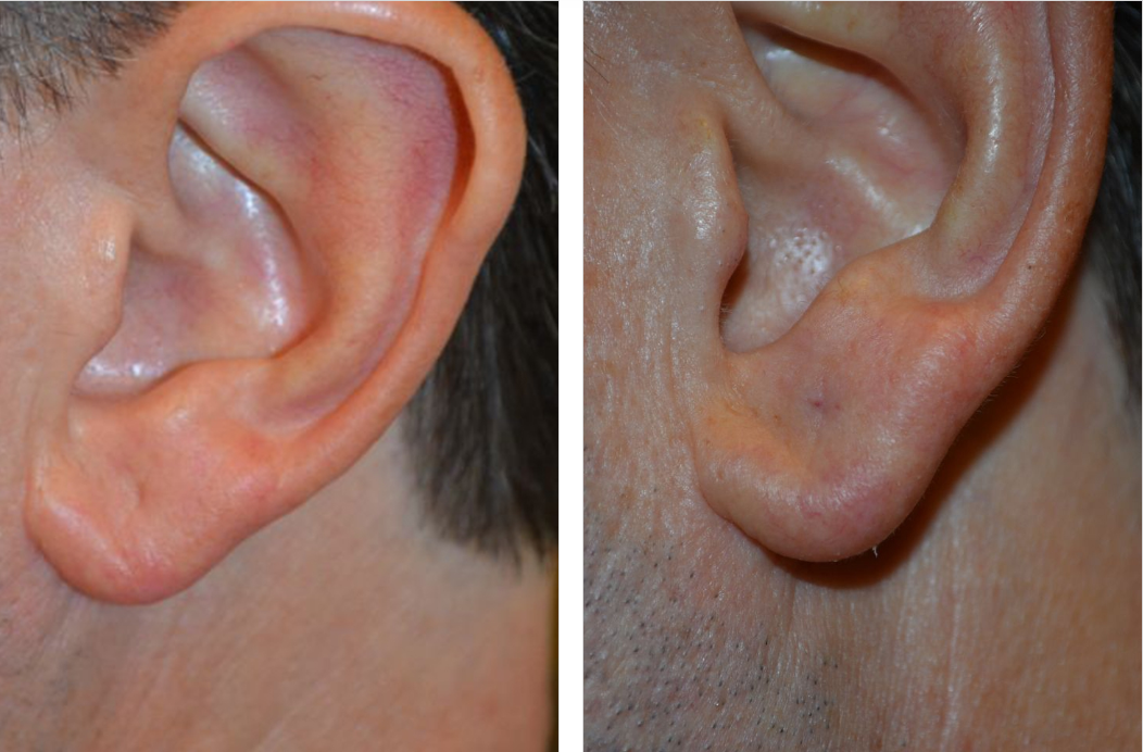 Two human ears; one from the side, one from the front; pink flesh tones.