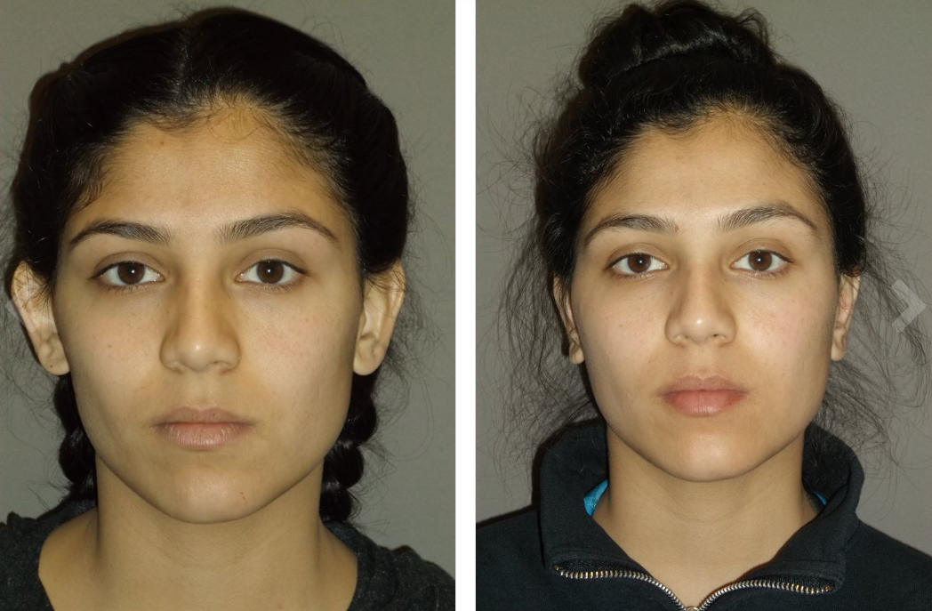 A woman's face before and after ear pinning surgery. Left: ears protrude. Right: ears less prominent.