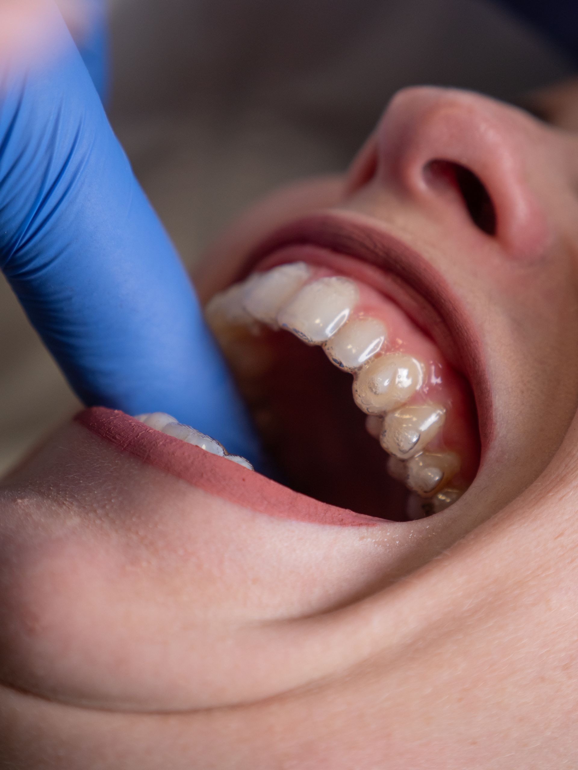 riabilitazione dell’Articolazione Temporo-Mandibolare