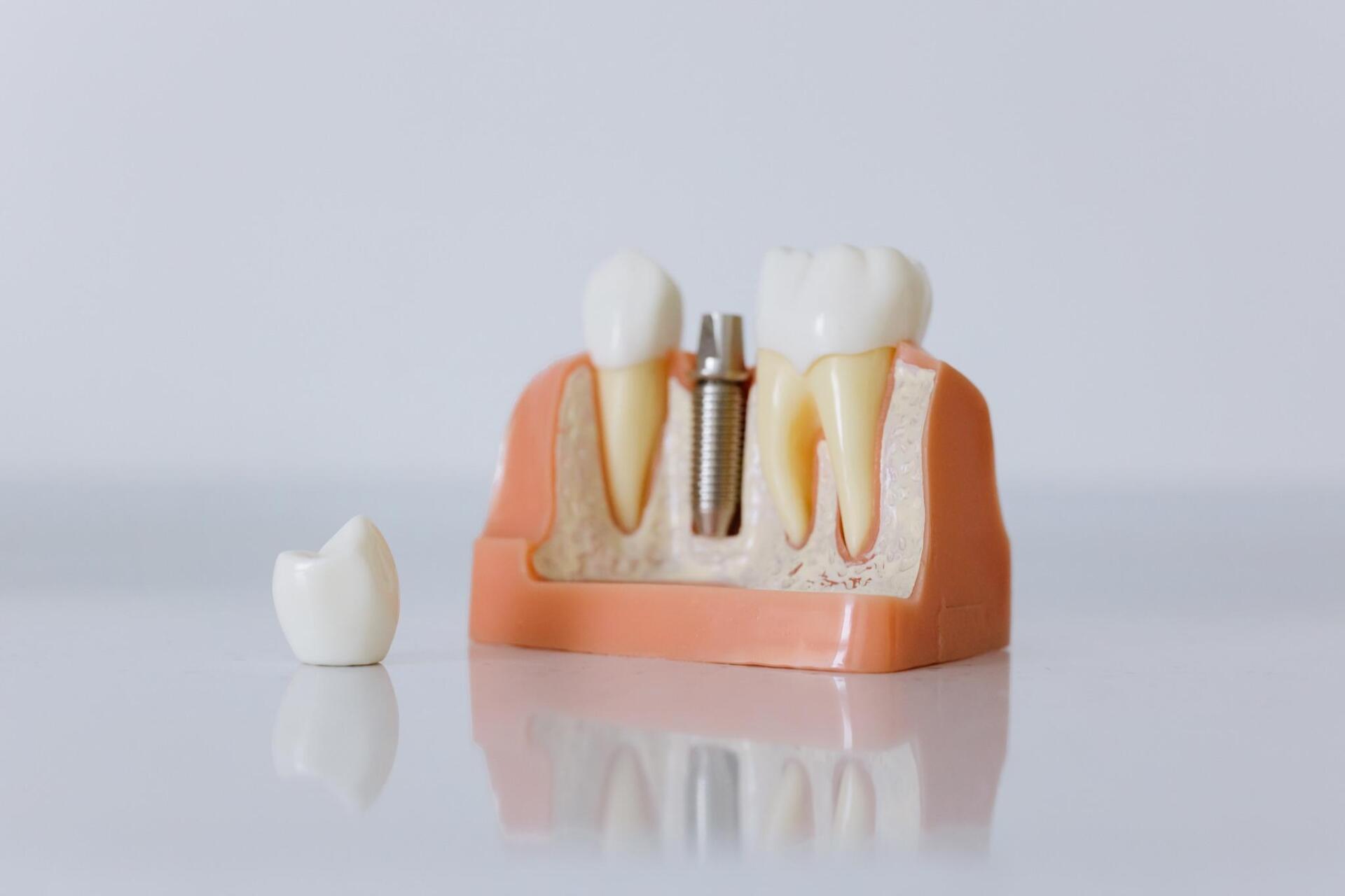 How Do Dental Implants Work 