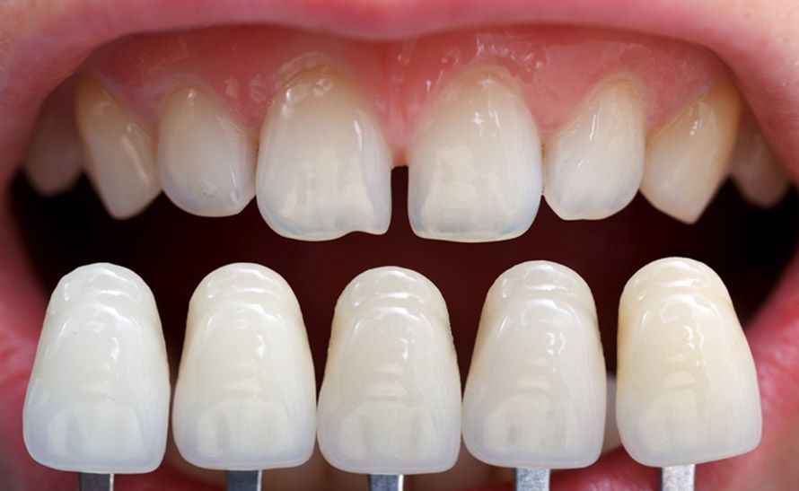 Everything You Need to Know Before Getting Veneers