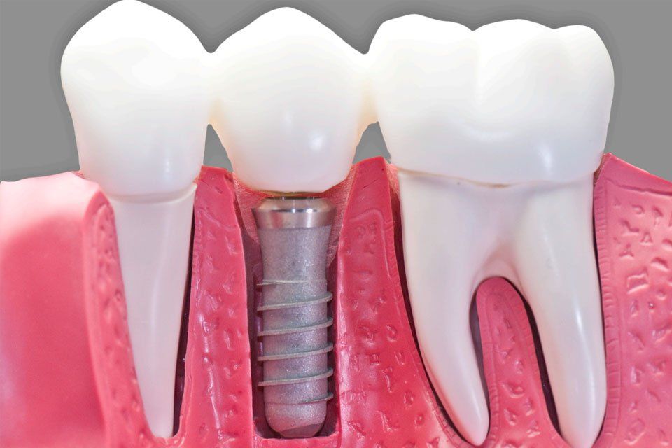 how is a crown attached to a dental implant