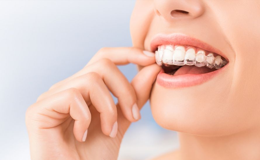 What Happens After the Last Invisalign Tray?