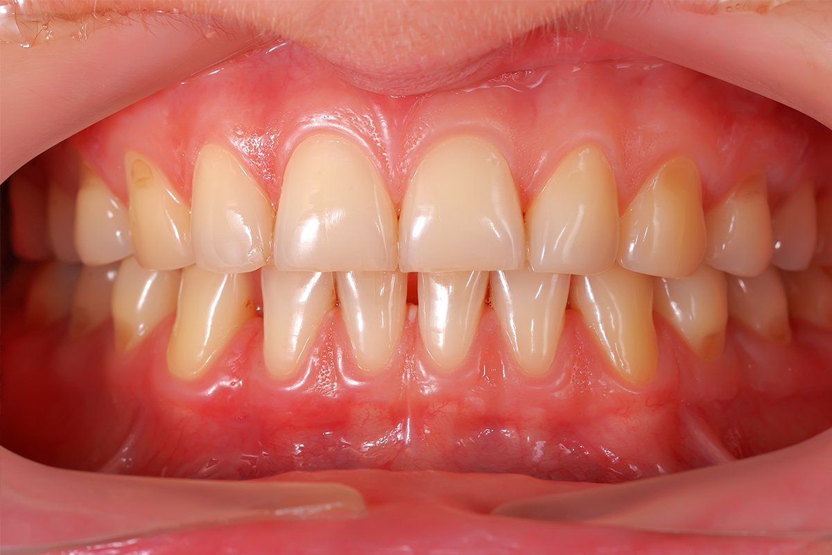 Fluoride Decay Prevention - Glenlake Dental Care