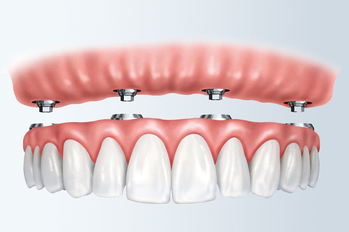 Implant Supported Dentures