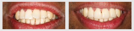 Before and After - Glenlake Dental Care
