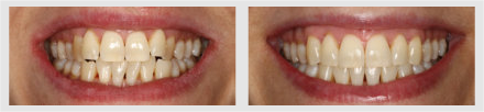 Before and After - Glenlake Dental Care