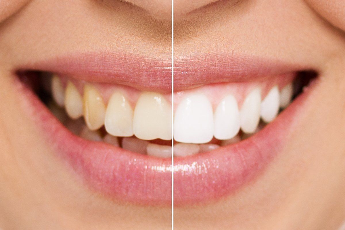 Zoom! Whitening