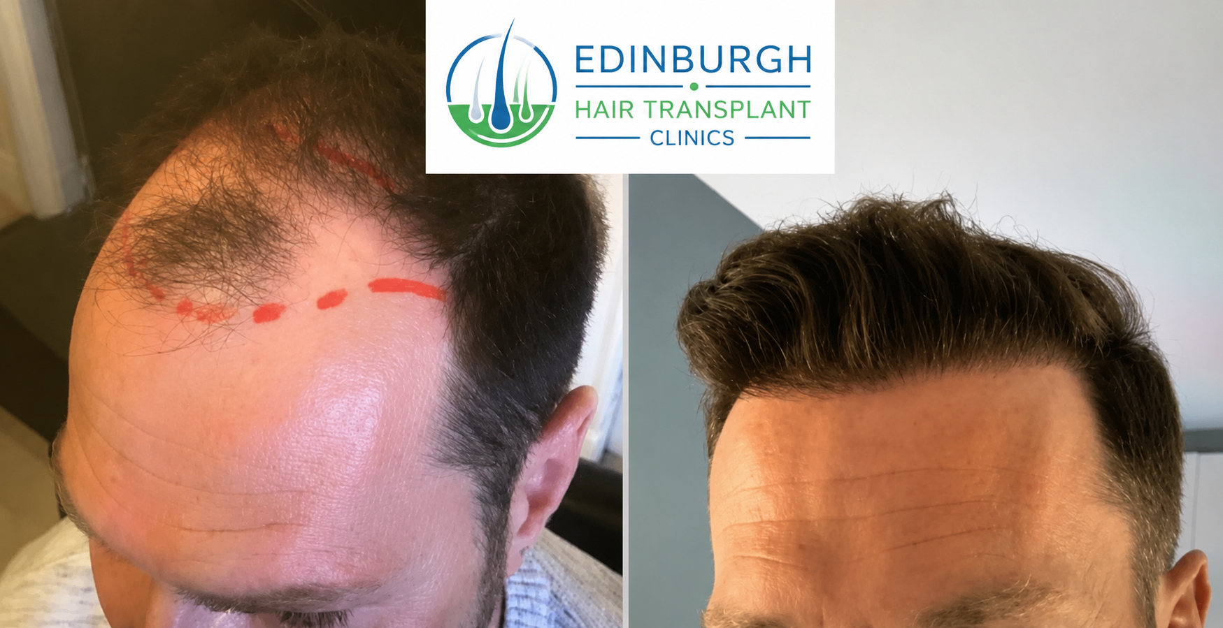Temple hair transplant patient result in Edinburgh