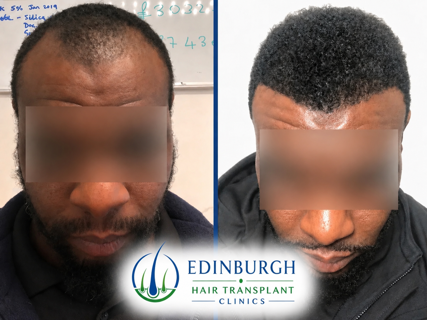 Before and after Afro hair transplant result