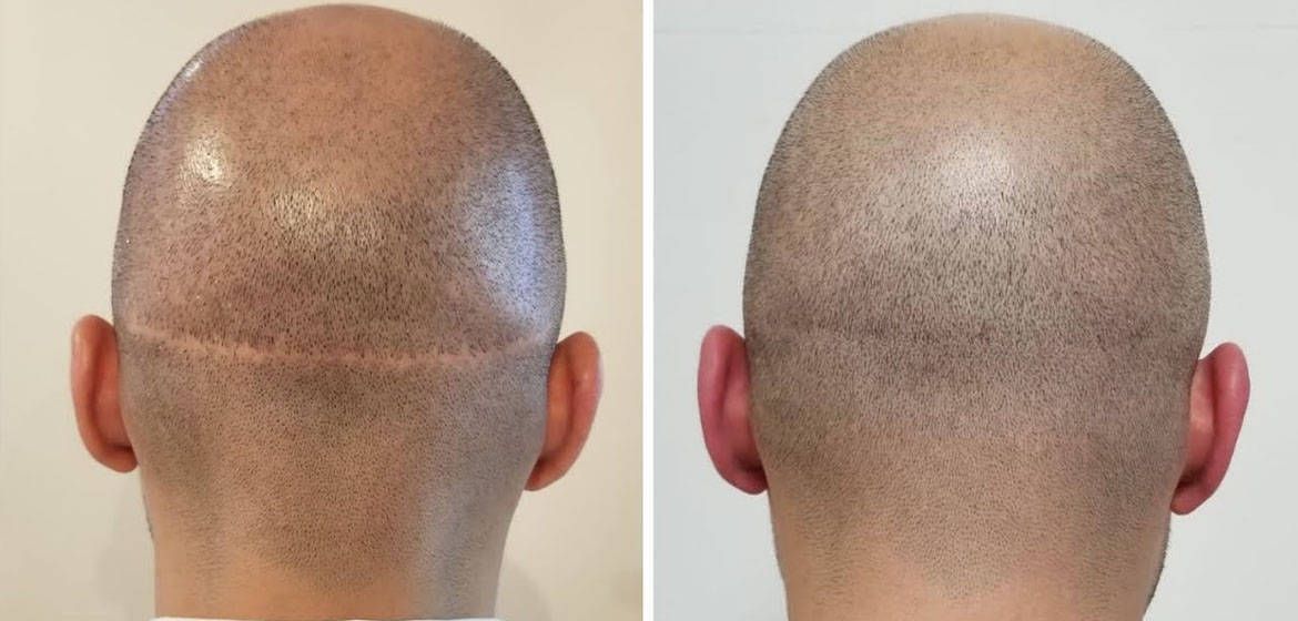 Scar hair transplant and scar camouflage patient example
