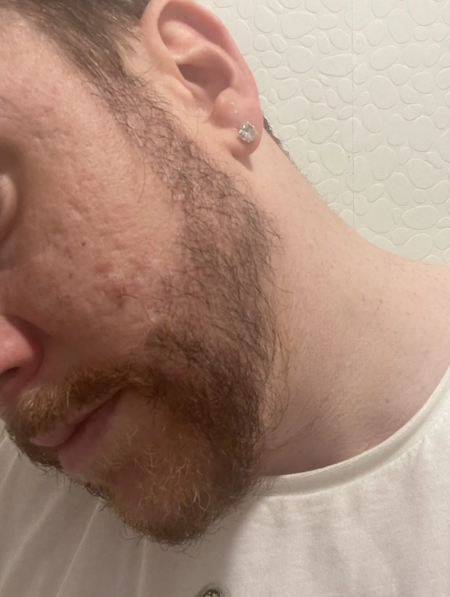 A picture of a male after a beard hair transplant