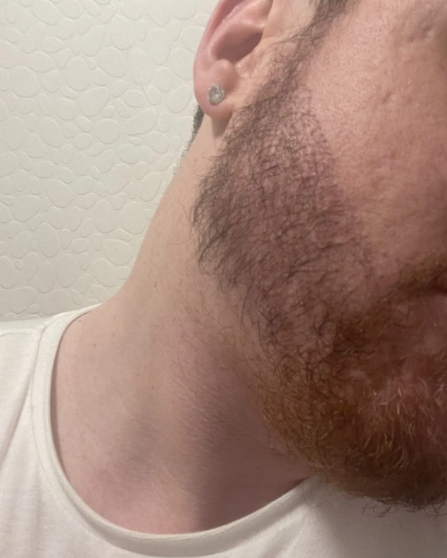 A picture of a male after a beard hair transplant