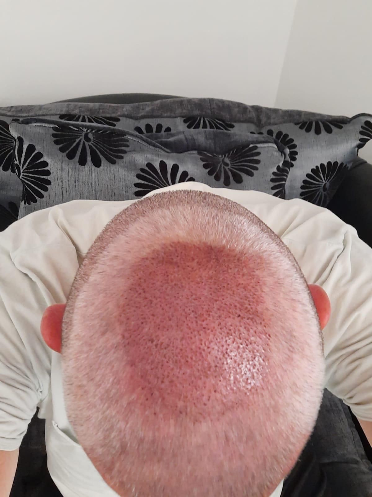 A picture of a hair transplant Edinburgh patient showing signs of male pattern baldness on the crown